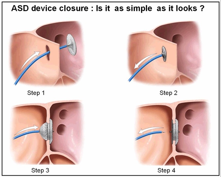 device-closure-of-asd-vsd-pda-dr-tejas-v-patel-cardiologist