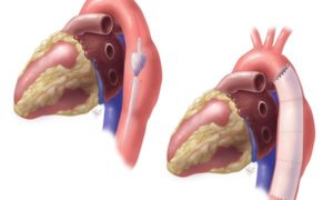 EVAR AND TEVAR FOR AORTIC DISSECTION/ANEURYSM | Dr. Tejas V. Patel