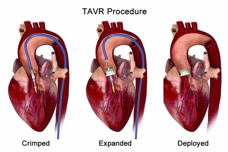 TAVR - Transcatheter Aortic Valve Replacement, Dr. Tejas V. Patel