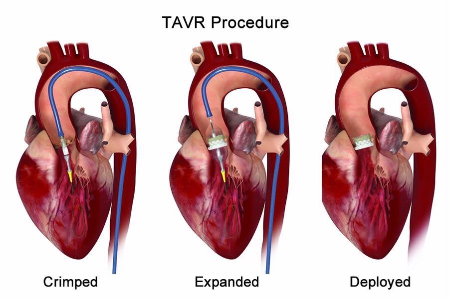 Complications Of Heart Valve Replacement