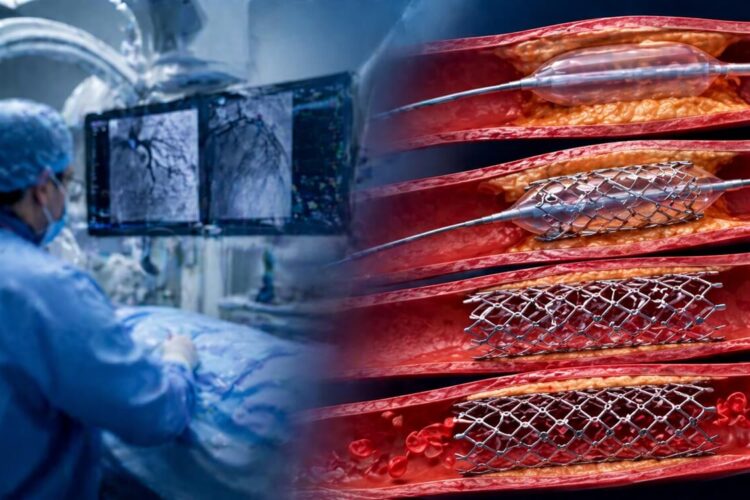 angioplasty_banner