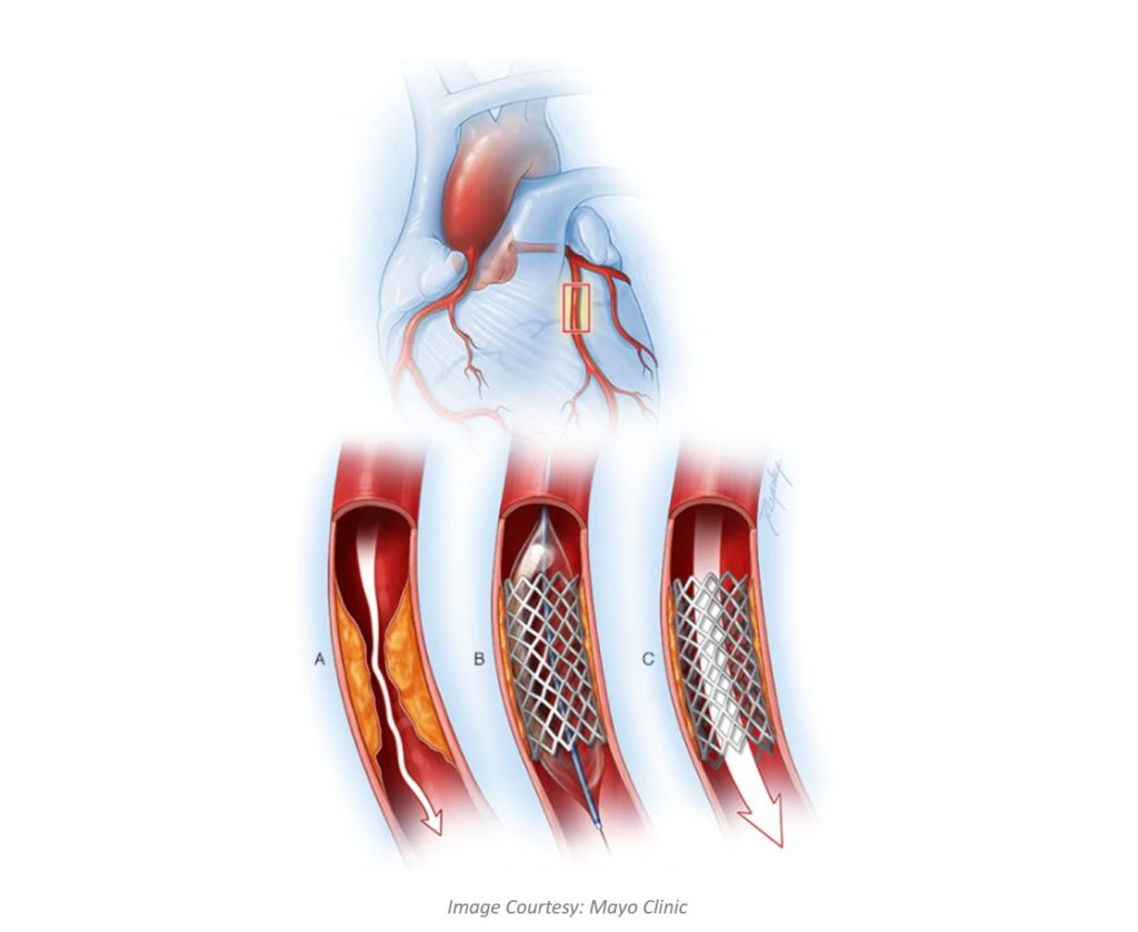 stent_placement